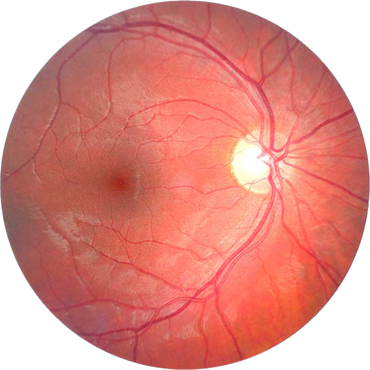Fundus photography showing the retina and optic disc of a human eye, indicating signs of glaucoma, an eye condition.